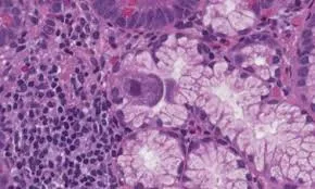 Precision Diagnostics for Viral Detection Using Cytomegalovirus PCR