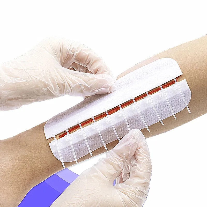 Wound Closure Device