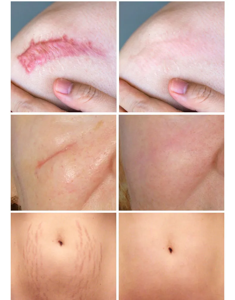 Medical Scar Removal gel with jar packing
